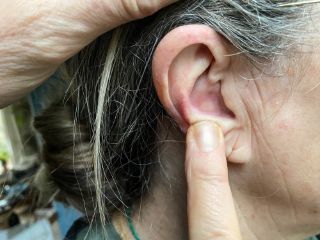Pimple in Ear